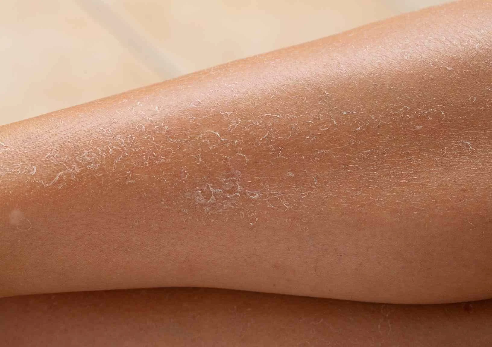 How to Get Rid of Dry Skin on Legs Moody Sisters Skincare